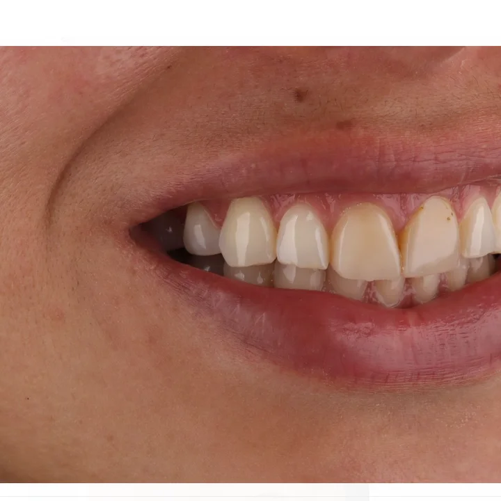 Antes: dientes desgastados y desiguales