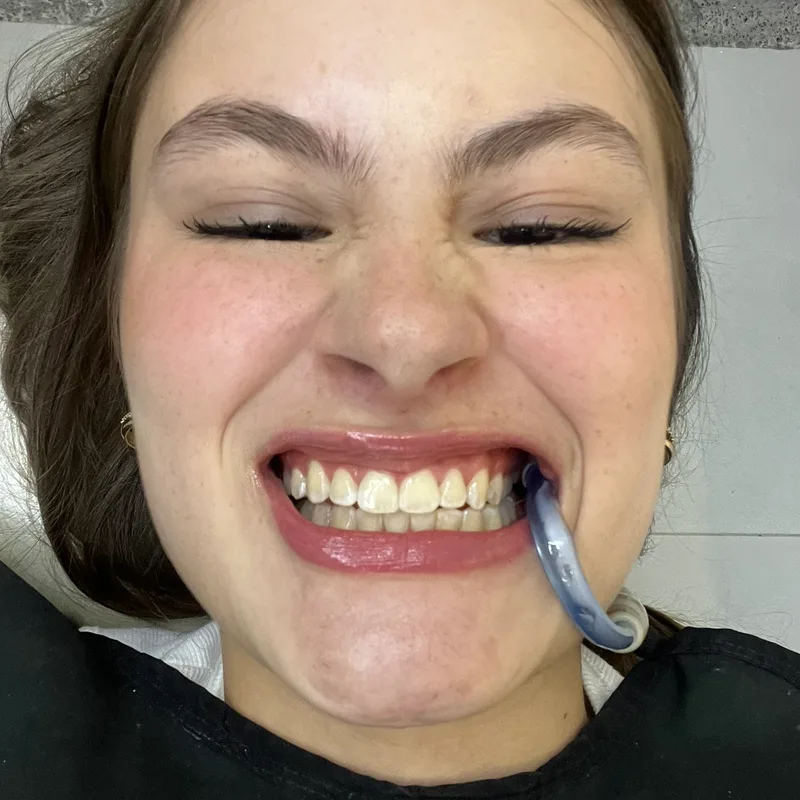 Antes: dientes amarillentos