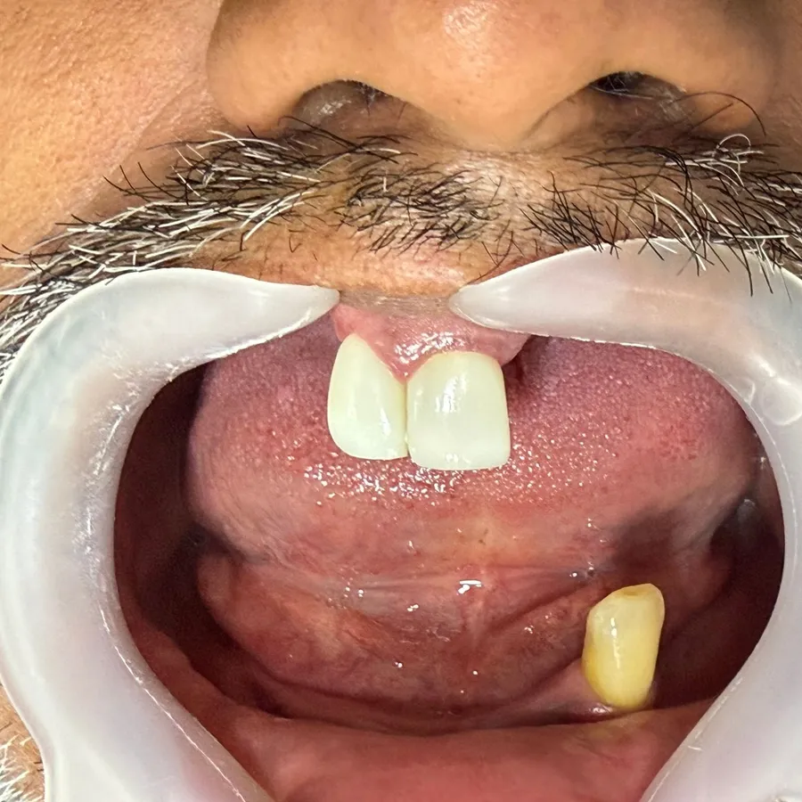 Antes: Carlos con pérdida de casi todos sus dientes