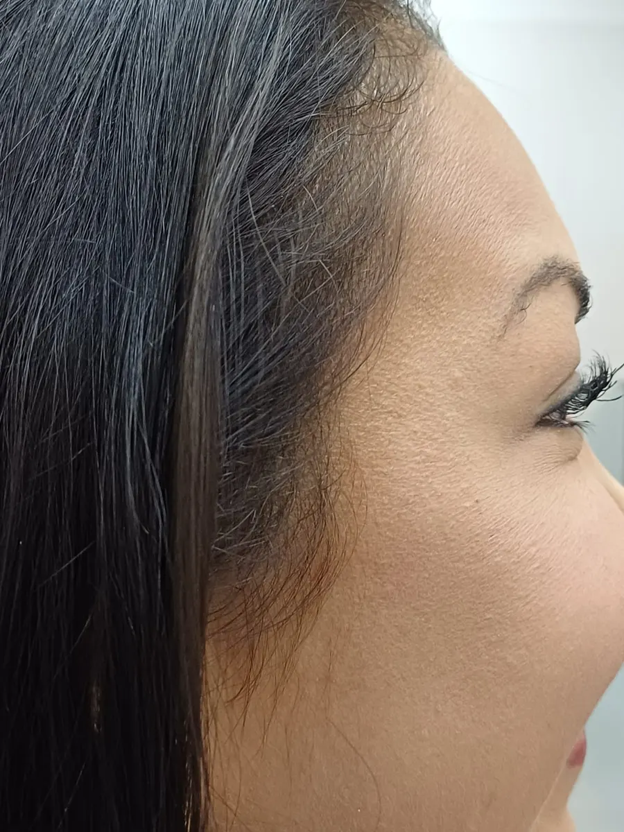 Después: armonización facial