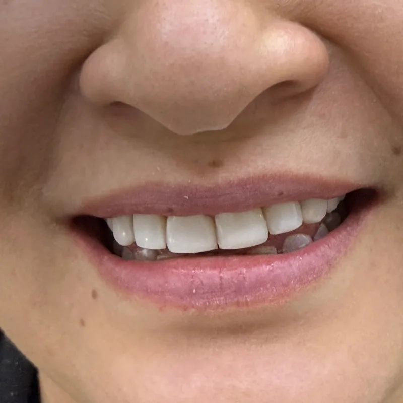 Después: sonrisa alineada y armónica