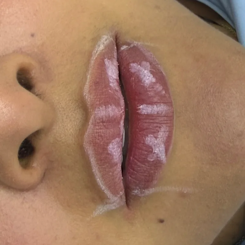 Después: labios con ácido hialurónico