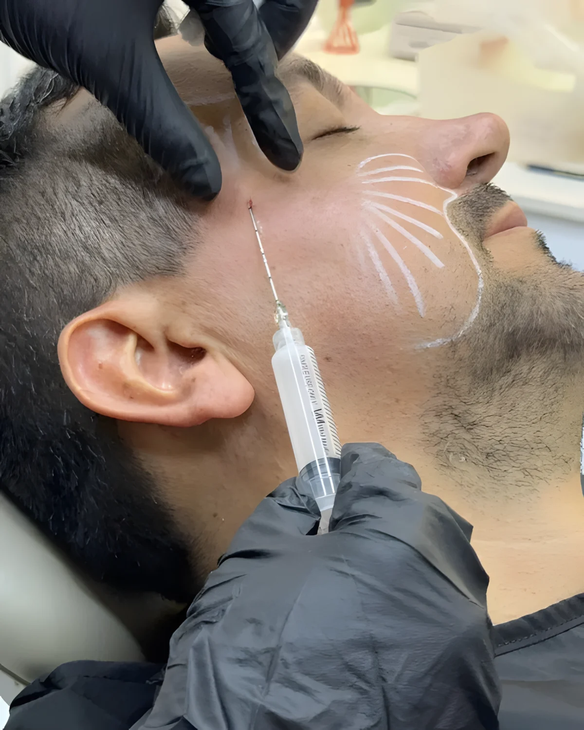 Aplicación de toxina botulínica en paciente masculino
